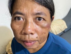 Aniaya ART, Oknum Dokter PNS di Bandarlampung Dilaporkan ke Polisi